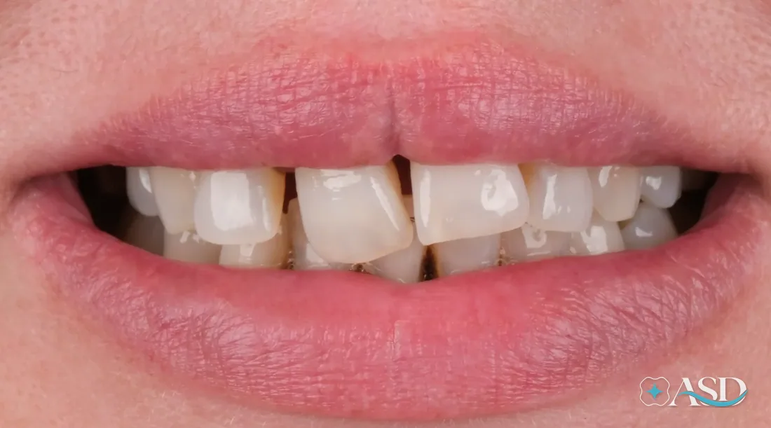 Crowns case 1, before treatment