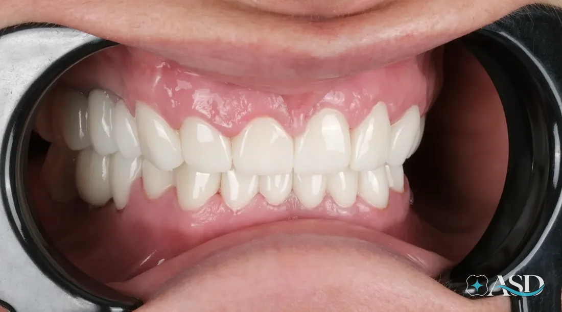 Crowns case 10, after treatment