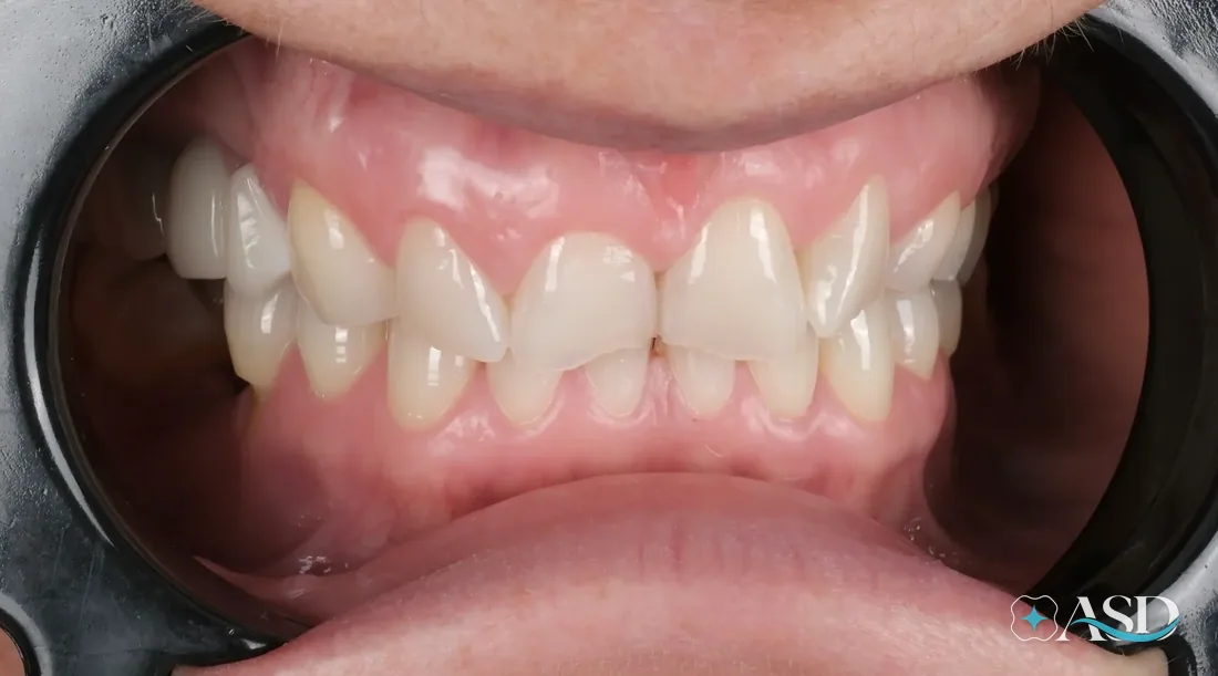 Crowns case 10, before treatment
