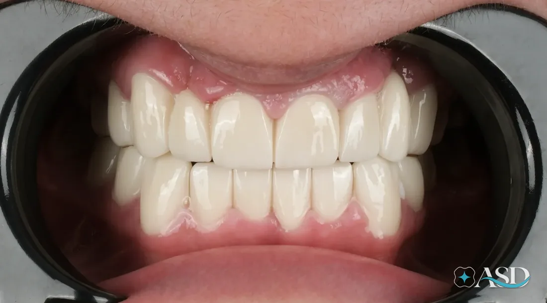 Crowns case 11, after treatment