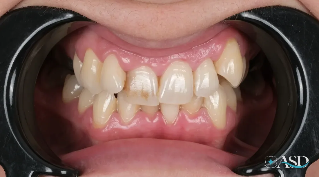 Crowns case 11, before treatment