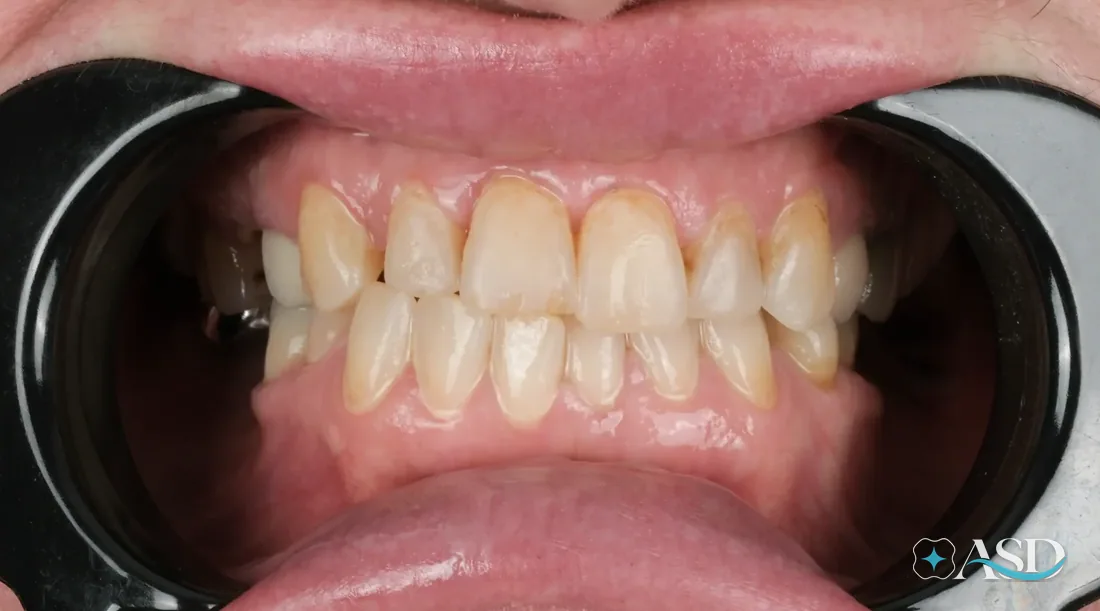 Crowns case 12, before treatment