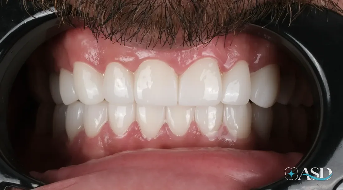 Crowns case 13, after treatment
