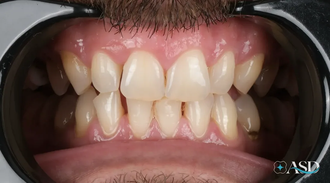Crowns case 13, before treatment