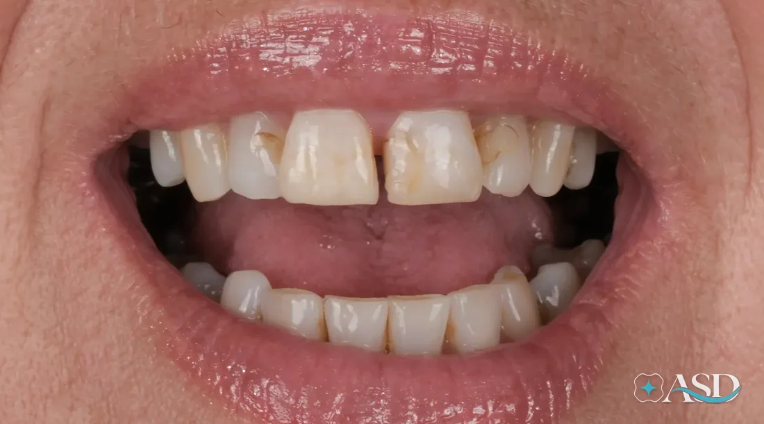 Crowns case 14, before treatment