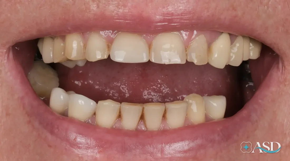 Crowns case 15, before treatment