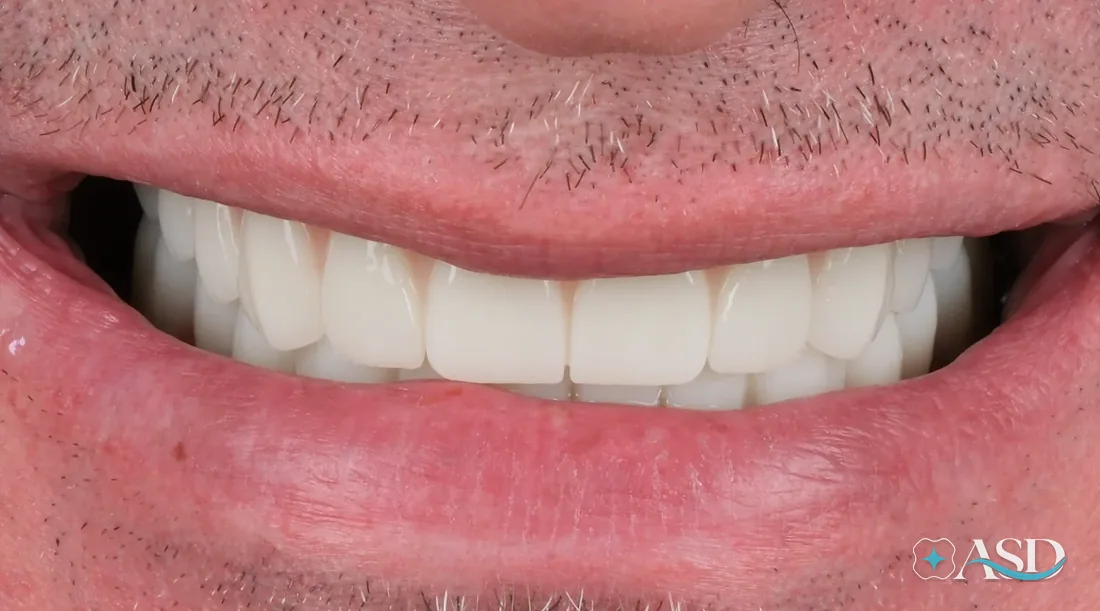Crowns case 2, after treatment