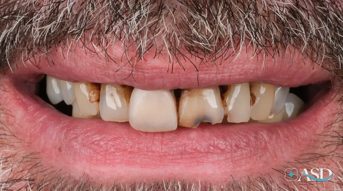 Crowns case 2, before treatment