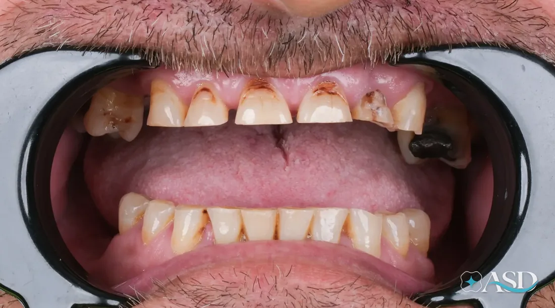 Crowns case 3, before treatment