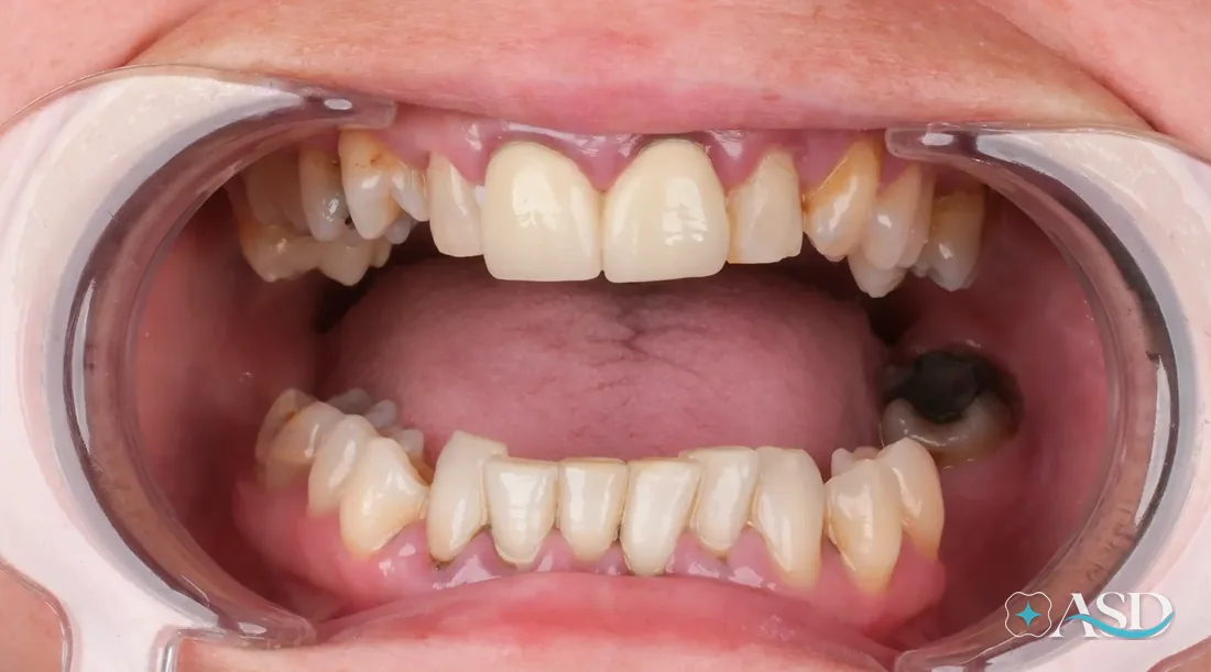 Crowns case 4, before treatment