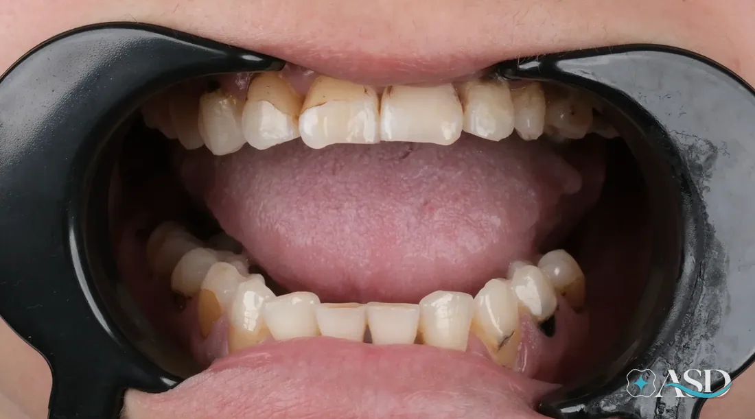 Crowns case 5, before treatment
