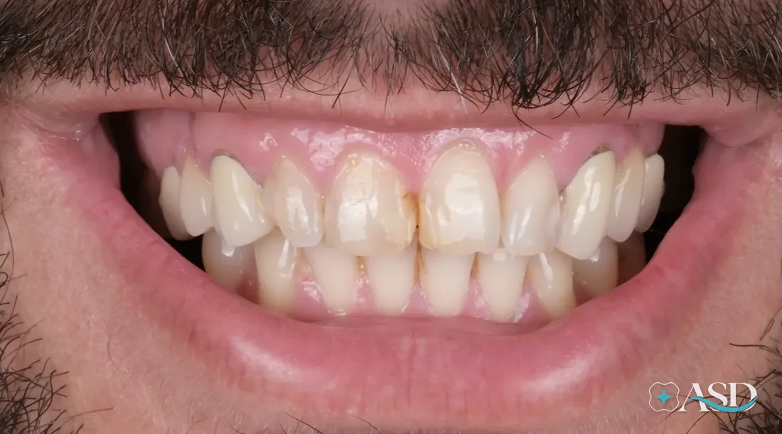 Crowns case 6, before treatment