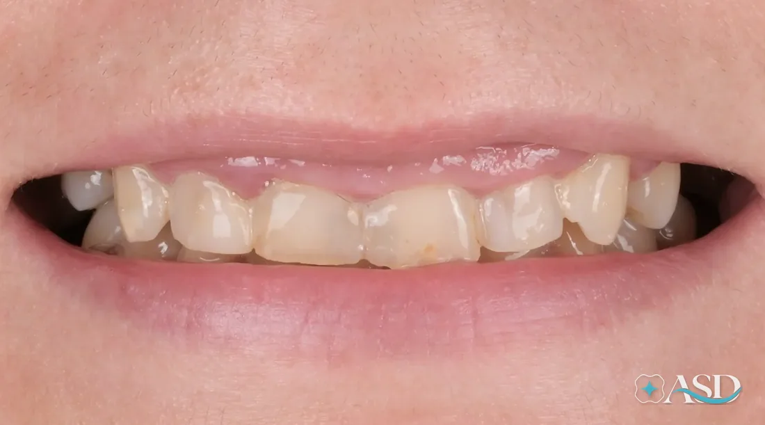 Crowns case 7, before treatment