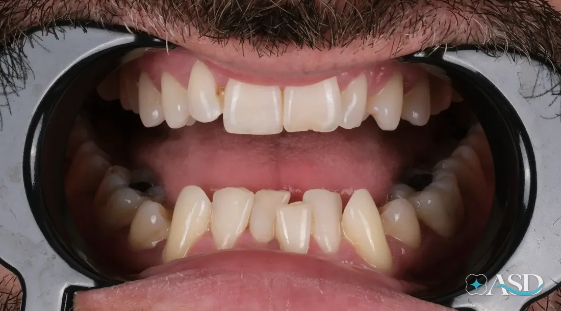 Crowns case 8, before treatment