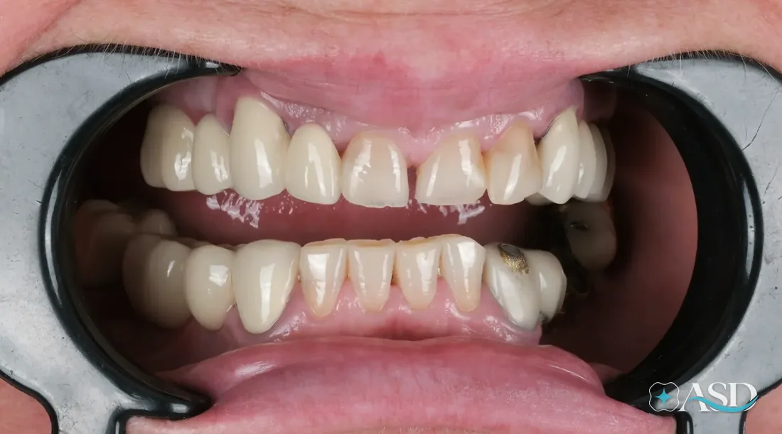 Crowns case 9, before treatment