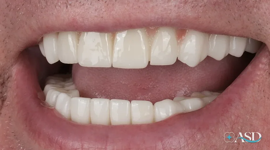 Dental implants case 1, after treatment