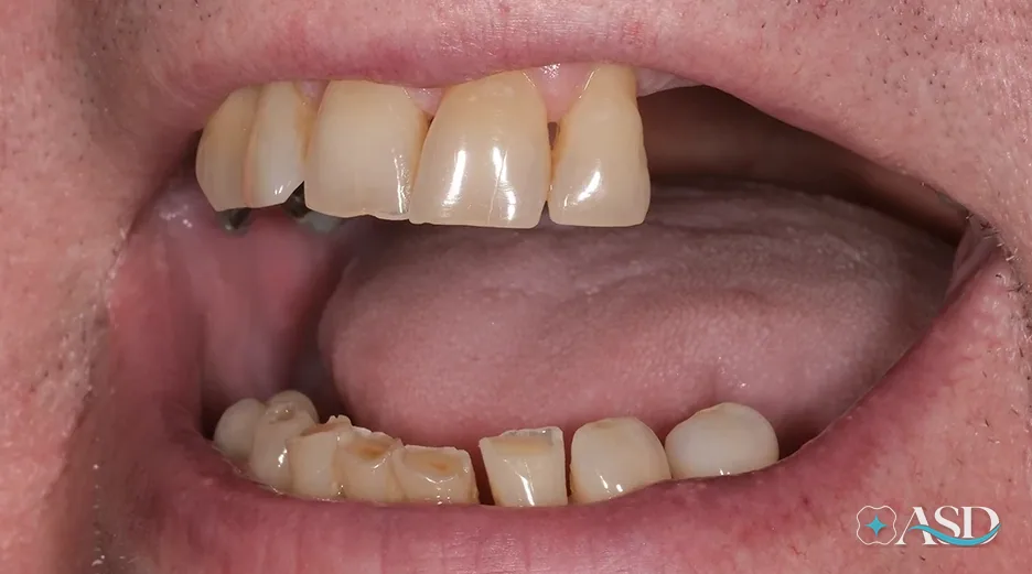 Dental implants case 1, before treatment