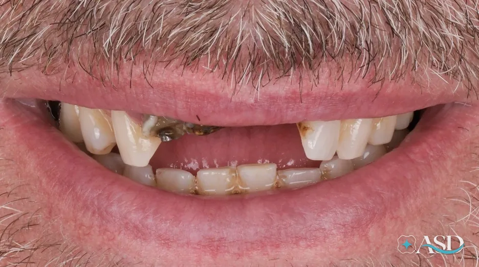 Dental implants case 10, before treatment