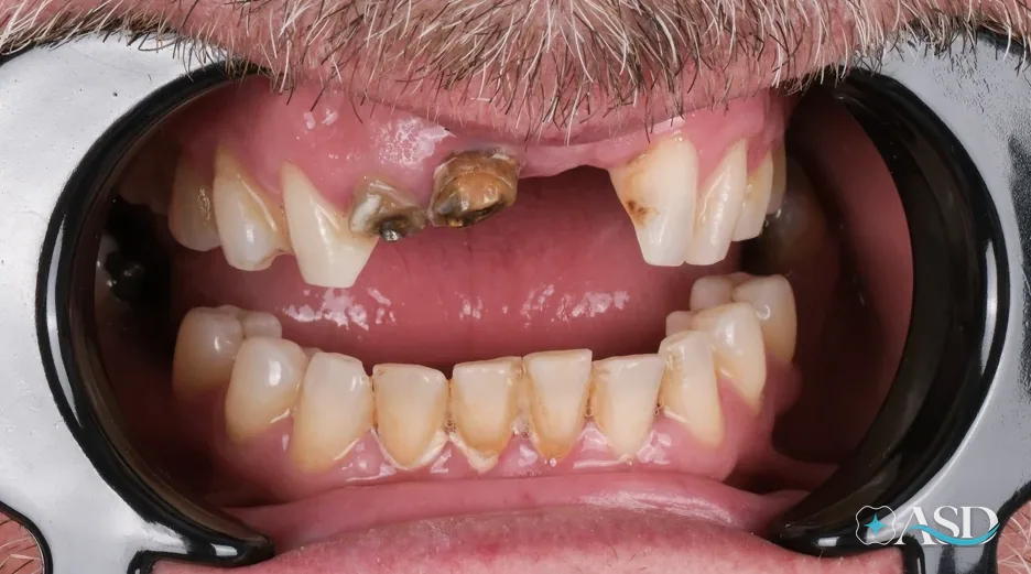 Dental implants case 11, before treatment