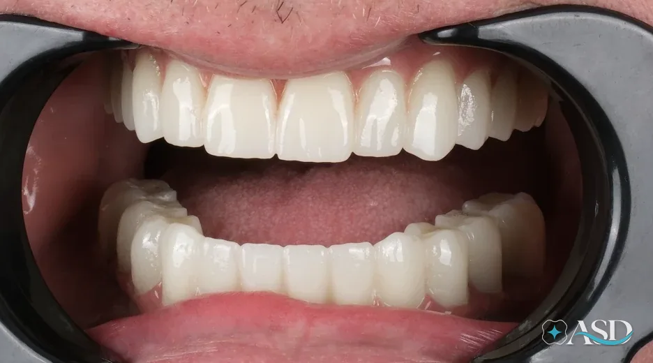Dental implants case 12, after treatment