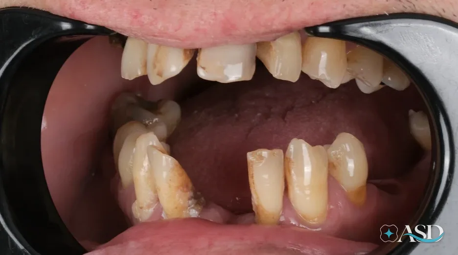 Dental implants case 12, before treatment