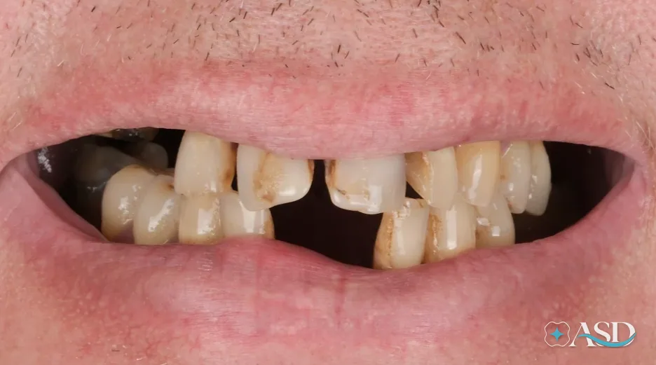 Dental implants case 13, before treatment