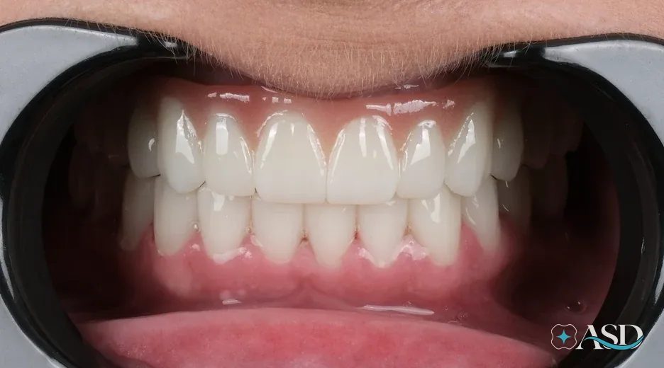 Dental implants case 14, after treatment