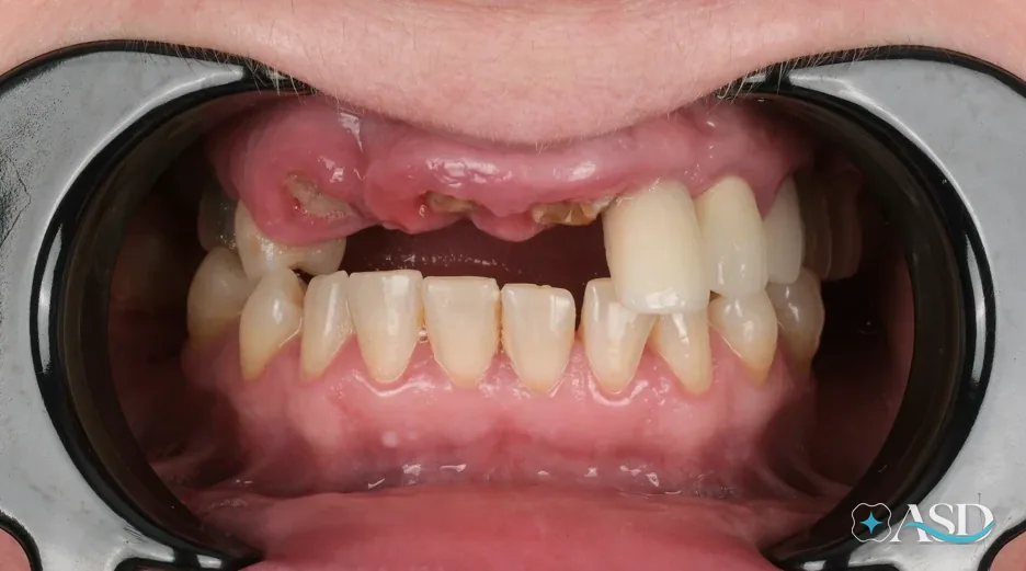 Dental implants case 14, before treatment