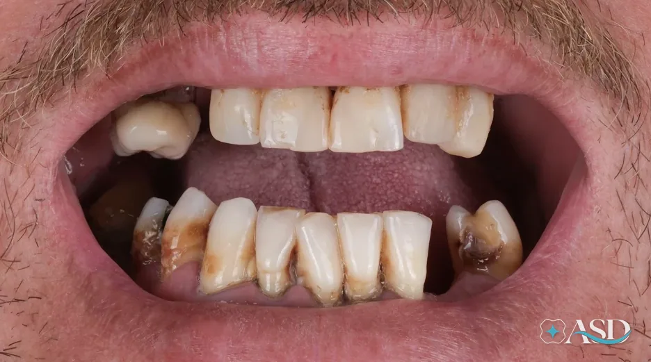 Dental implants case 15, before treatment