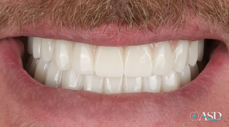 Dental implants case 16, after treatment
