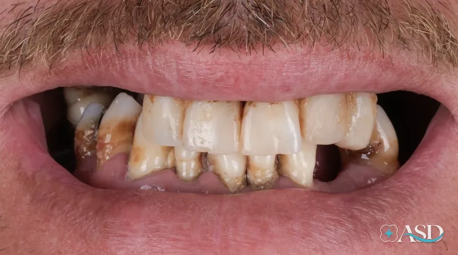 Dental implants case 16, before treatment