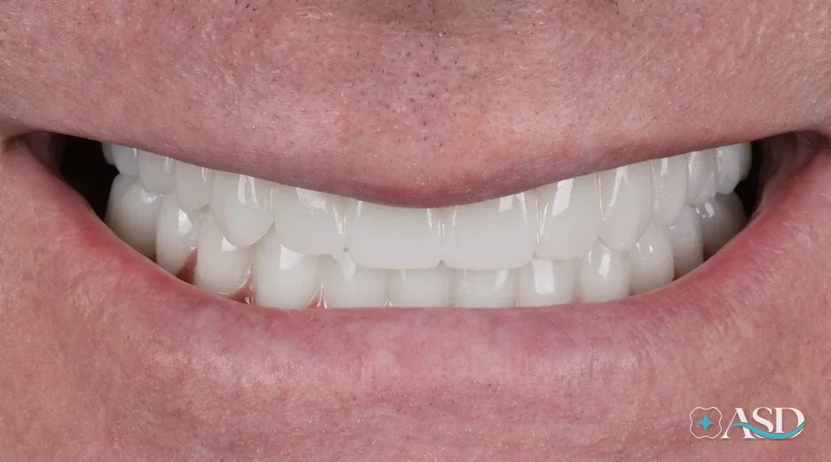 Dental implants case 17, after treatment