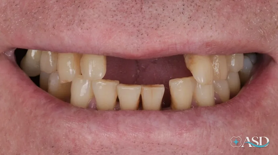 Dental implants case 17, before treatment