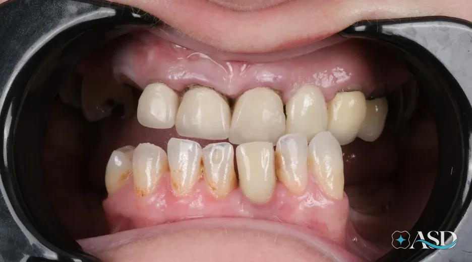Dental implants case 18, before treatment