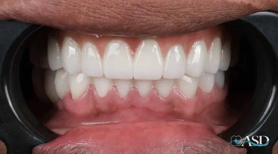 Dental implants case 19, after treatment
