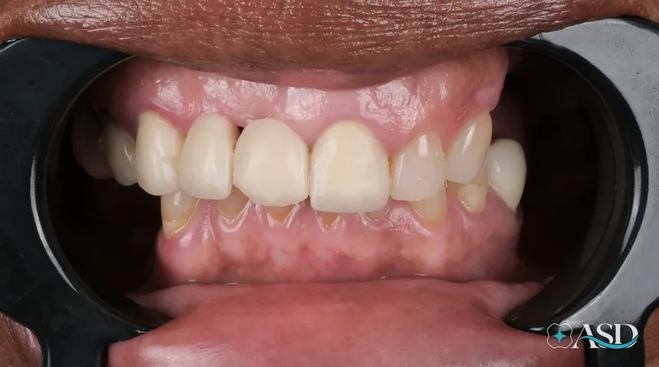 Dental implants case 19, before treatment