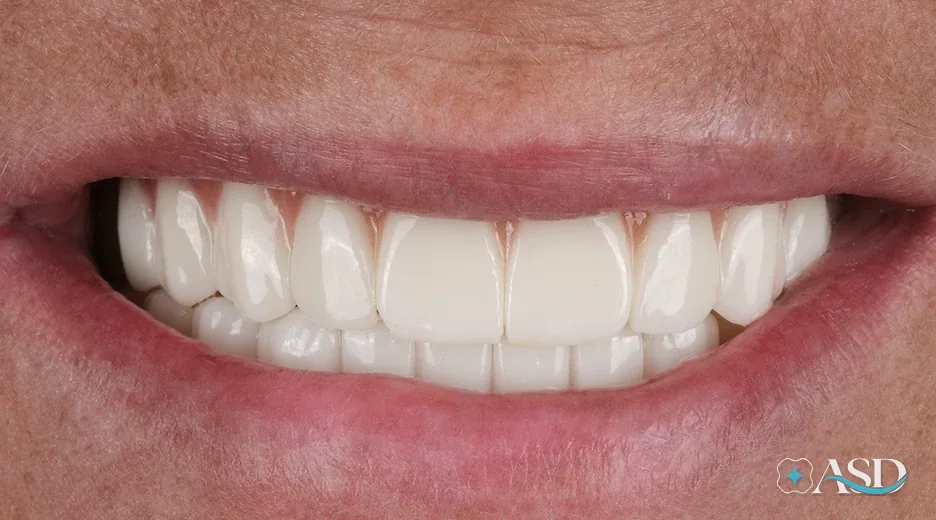 Dental implants case 2, after treatment