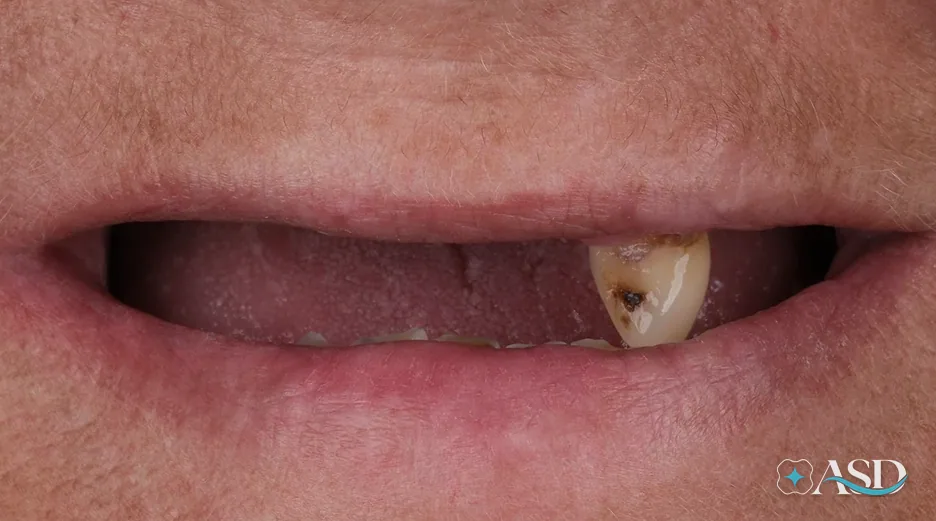 Dental implants case 2, before treatment