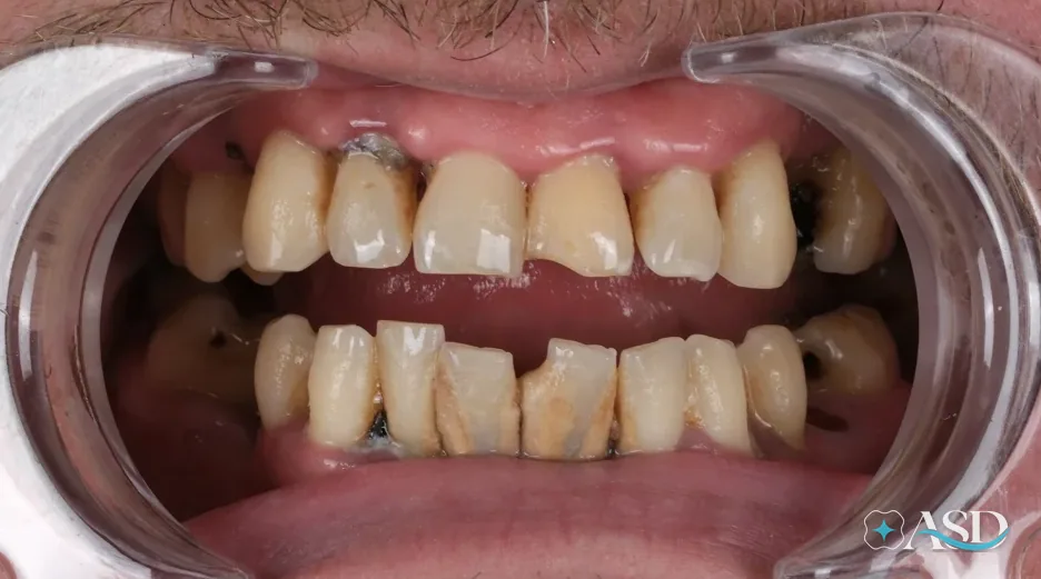 Dental implants case 20, before treatment