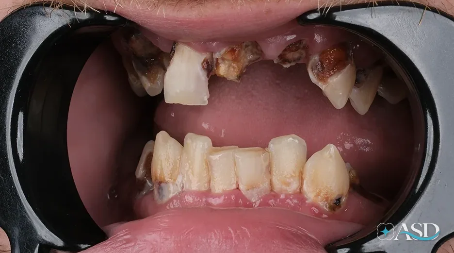 Dental implants case 3, before treatment