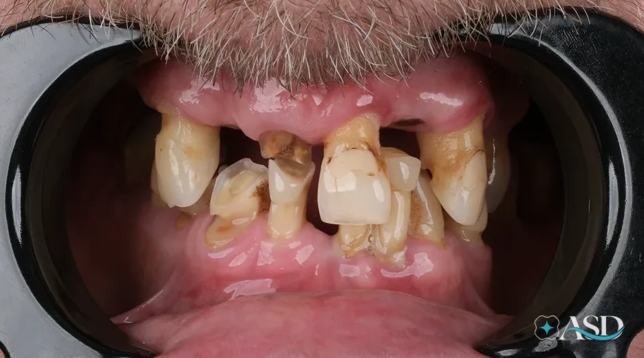 Dental implants case 4, before treatment