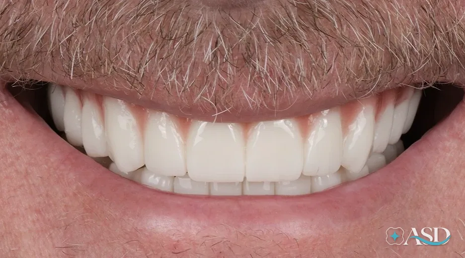 Dental implants case 5, after treatment