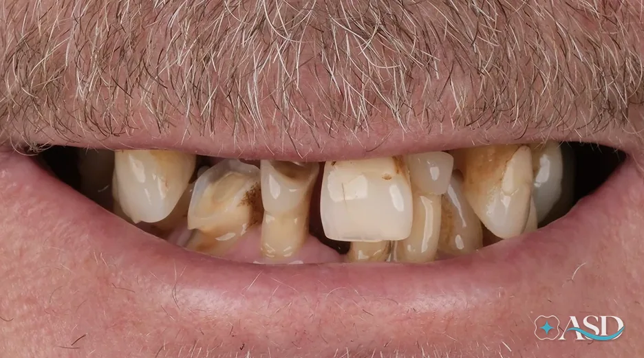 Dental implants case 5, before treatment