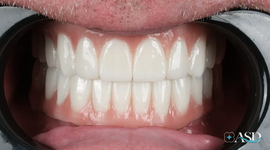 Dental implants case 6, after treatment
