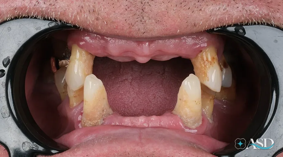 Dental implants case 6, before treatment