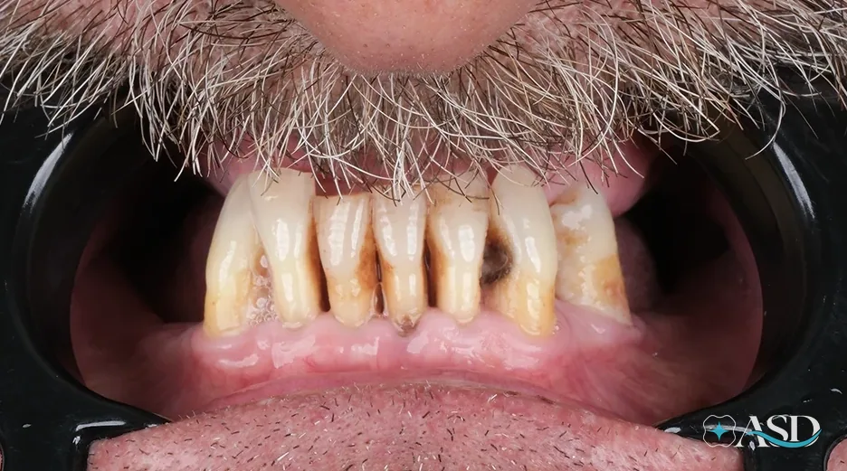 Dental implants case 7, before treatment