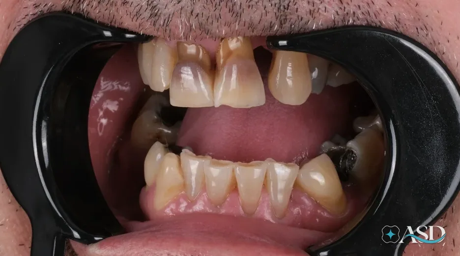 Dental implants case 8, before treatment