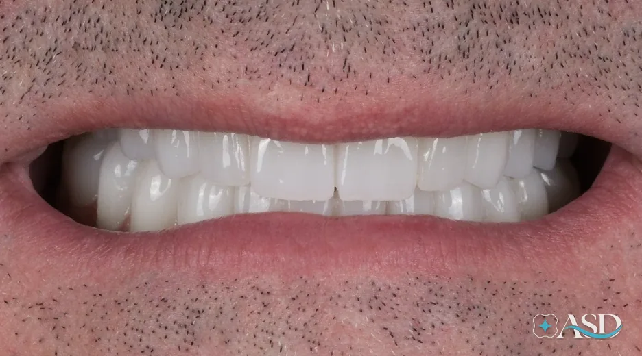 Dental implants case 9, after treatment