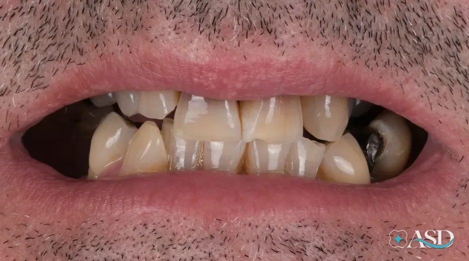Dental implants case 9, before treatment