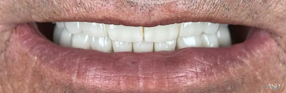 Smile-Makeover-Fall, nach der Behandlung